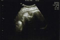 Ultrasounds